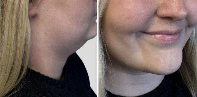HAPPY CHIN - INSTANT CHIN & NECK LIFT - One Size